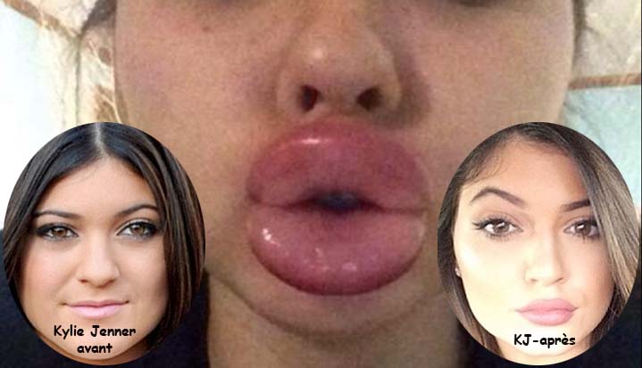 Kylie Jenner et ses levres