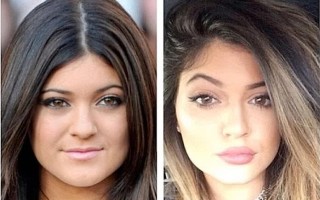 Kylie Jenner après avoir fait gonfler ses lèvres, veut à présent retrouver la finesse de ses lèvres