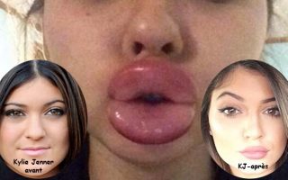 Kylie Jenner et ses levres