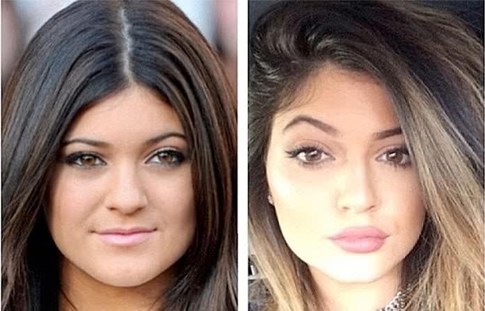 Kylie Jenner après avoir fait gonfler ses lèvres, veut à présent retrouver la finesse de ses lèvres